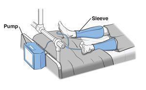 Patient in hospital bed wearing equential compression sleeves on legs.