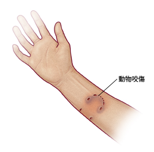 人的手臂所示为因动物咬伤导致的穿刺伤。标签：动物咬伤