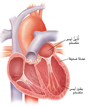 مقطع عرضي لقلب متضخم. جدران القلب غير سميكة.