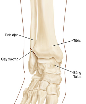 Xương của cẳng chân và mắt cá chân, bao gồm xương sợi, xương chày và xương talus. Các sợi xương nằm gần xương chày và khớp cắn cho thấy một chỗ gãy trong xương.