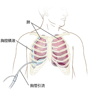 男子胸部正視圖顯示從肺旁胸腔排积液的導管。